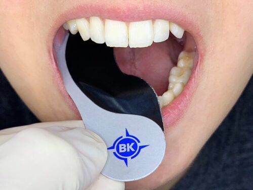 Blog o okluzji - artykuły o okluzji: Kalki. Praktyczny przewodnik