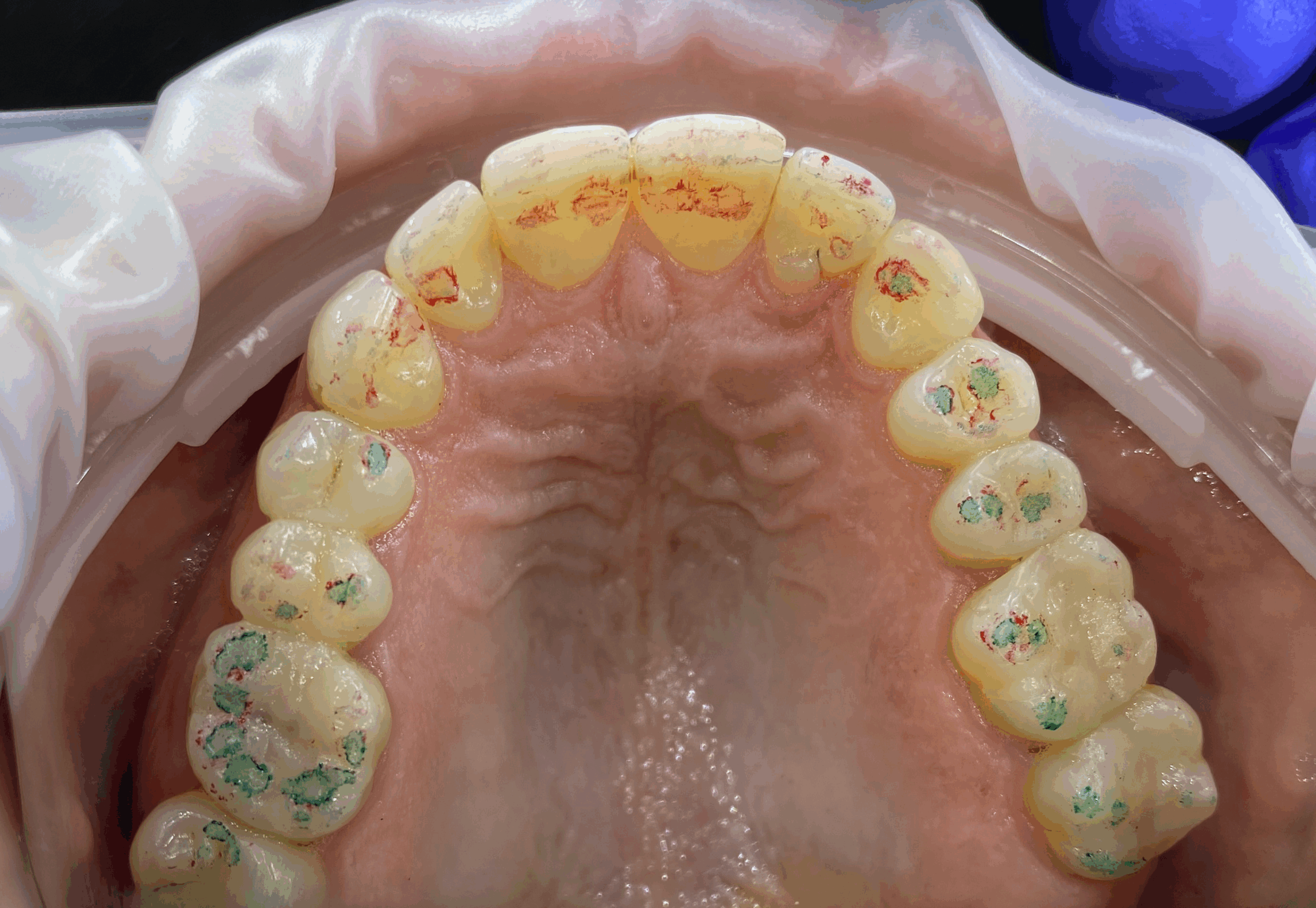 Blog o okluzji - artykuły o okluzji: Kontrola okluzji